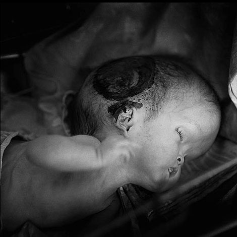 chernobyl victims photos. Newborn - Chernobyl victim